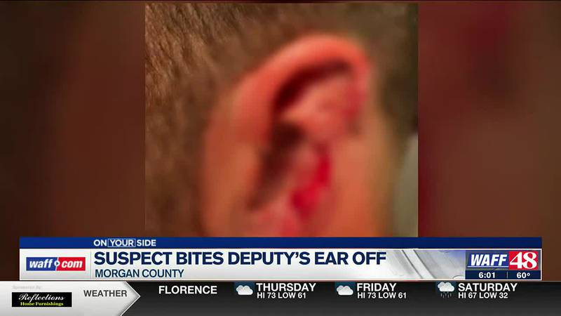 The deputy was taken to Huntsville Hospital where doctors determined his ear could not be...